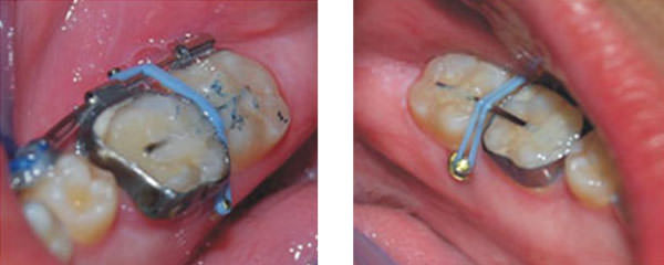 Figura 10 Mini-implantes en el arco inferior