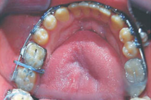 Figura 11 Mini-implantes en el arco inferior