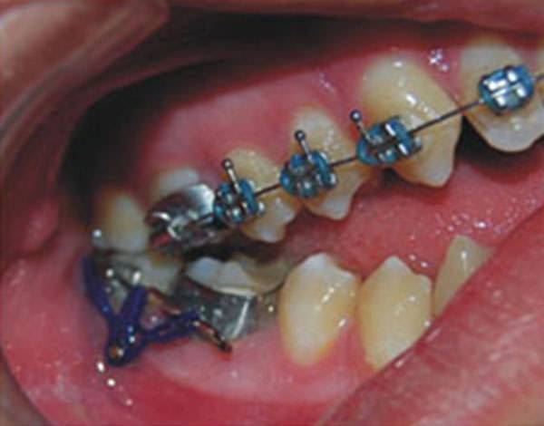 Figura 12 Mini-implantes para intrusión de 6 y 7 inferiores, lado derecho