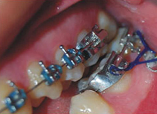 Figura 13 Mini-implantes para intrusión de 6 y 7 inferiores, lado izquierdo