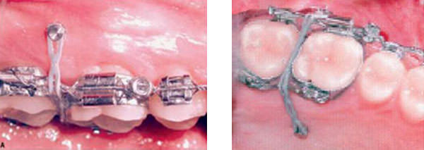 Figura 14 Mini-implantes en el arco superior