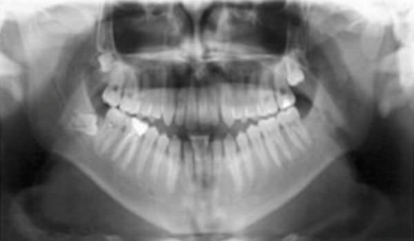 Figura 4 Radiografía Panorámica