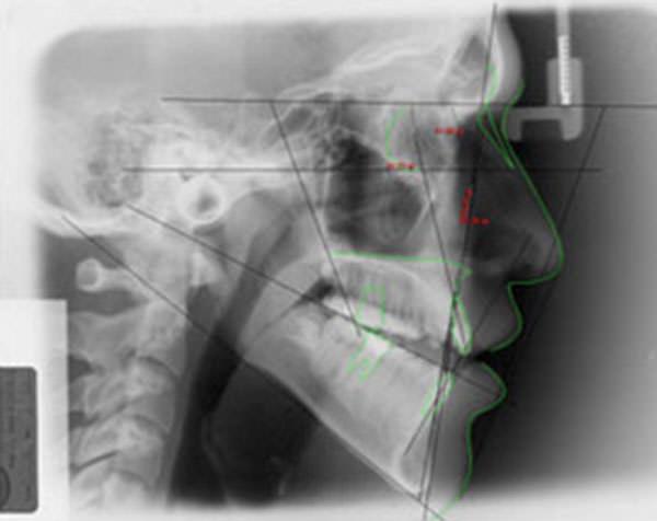 Figura 5 Radiografía Cefálica Lateral