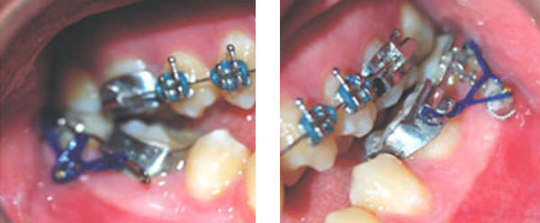 Figura 9 Mini-implantes en el arco inferior