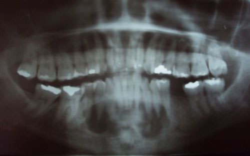 FIGURA 1 RADIOGRAFIA PANORÁMICA: SE OBSERVA IMAGEN RADIOLÚCIDA, BORDES DEFINIDOS, CON FOCOS RADIOPACOS, SE EXTIENDE DE 35 A 45, NO COMPROMETE LA BASAL MANDIBULAR Y CON PERSISTENCIA DE LA CORTICAL ÓSEA BUCAL Y DE CUERPO MANDIBULAR.