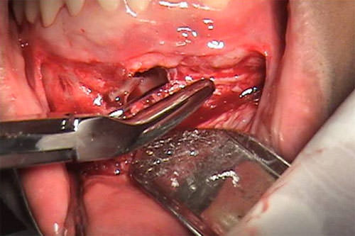 FIGURA 2 CON PINZA GUBIA SE PROCEDE A REALIZAR OSTECTOMÍA DE LA PARED VESTIBULAR, SE PRESERVA EL HUESO SANO DE LA BASAL MANDIBULAR.