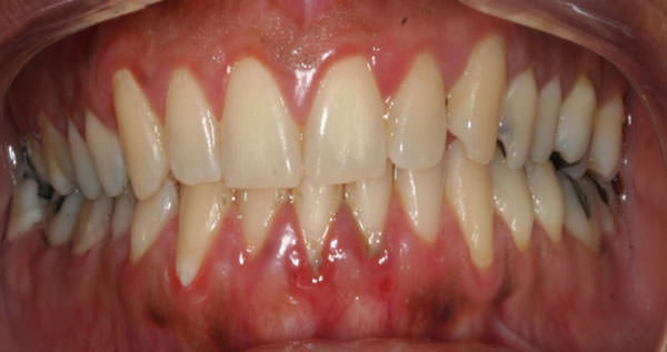 Fig. 1 Foto intrabucal de la paciente. Presencia de irritantes locales, restauraciones dentales, y en zona gingival aumento de volumen, cambio de coloración rojizo y máculas irregulares parduzcas.