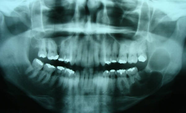 Fig. 2 Radiografía panorámica donde se observa imagen radiolúcida multilocular en la zona mandibular izquierda. Rizalisis de primer y segundo molar contiguo a la zona.