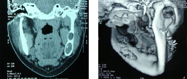 Fig. 3 Tomografía Computarizada, corte coronal y reconstrucción 3D en cual se observa la lesión intraósea y la fenestración de la cortical lingual.