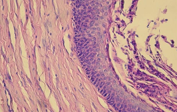 Fig. 4 Imagen microscópica 40X de la biopsia de la lesión. Se aprecia el epitelio odontogénico paraqueratinizado y los filamentos de queratina y células descamadas en el lumen de la lesión tumoral.