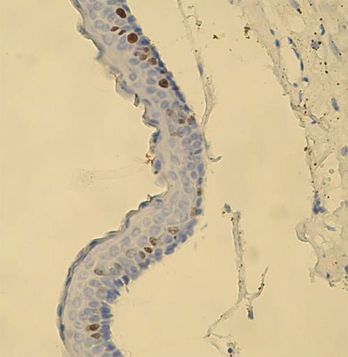 Fig.5 Microfotografía de la expresión de la proteína Ki-67 (núcleos marrones) mediante estudios de inmunohistoquímica en el epitelio de la lesión.