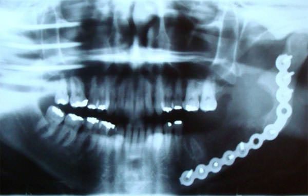 Fig.6 Control radiográfico 2 meses después de la eliminación quirúrgica del tumor.