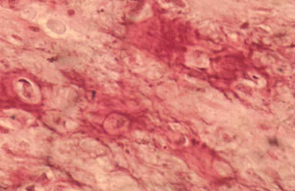 Figura 1 Microfotografia mostrando áreas osteoides y células pleomórficas Tomado de Soares, 2005.