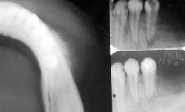 Figura 3 Vista de una radiografía oclusal mostrando la porción de la cortical externa con radiopacidad similar a rayos de sol (izq). Radiografia periapical mostrando el incremento espacio periapical del premolar (der). Tomado de Soares, 2005.