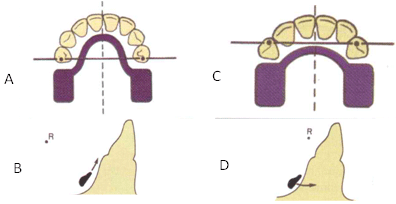Fig. 2 A y B Barrera lingual por delante del fulcro el arco de giro es paralelo a la encia y requiere menos alivio. C y D la barra lingual por detrás el arco de giro es perpendicular a la encía y requiere más alivio Tomado de Mallat y Mallat 8