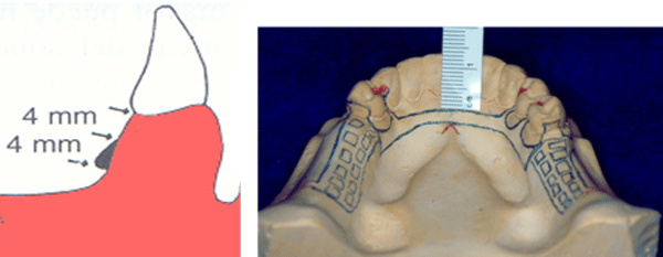 Fig. 3 Ubicación del borde superior de la barra.