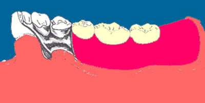 Fig. 4 Conector Mayor Placa Lingual