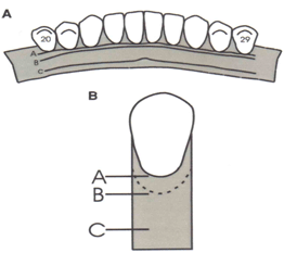 Fig. 5 Distancia (A-C) margen gingival - piso de la boca. Distancia (A-B) profundidad del surco gingival Yomado de Cameron et al 17