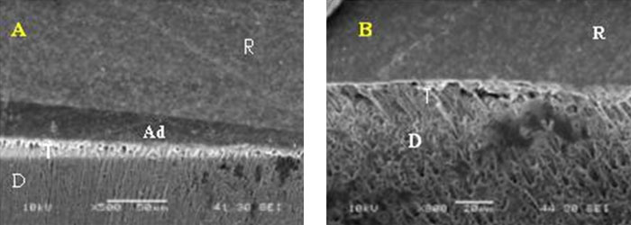 Figura 1 Fotomicrografia (MEB) de la interfaz adhesiva AdperTM Scotchbond Multi-Uso. (A) con NaOCl luego de 24 horas, y (B) NaOCl después de 6 meses. R = resina, Ad = adhesivo, T = tags, D = dentina.