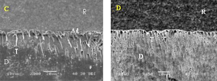 Figura 2 Fotomicrografia (MEB) de la interfaz adhesiva del AdperTMSingle Bond. (C) con NaOCl luego de 24 horas, y (D) NaOCl después de 6 meses. R = resina, Ad = adhesivo, T = tags, D = dentina.