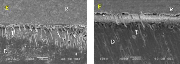 Figura 3 Fotomicrografia (MEB) de la interfaz adhesiva de XP Bond (E) con NaOCl luego de 24 horas, y (F) NaOCl después de 6 meses. R = resina, * = hendidura, T = tags, D = dentina.