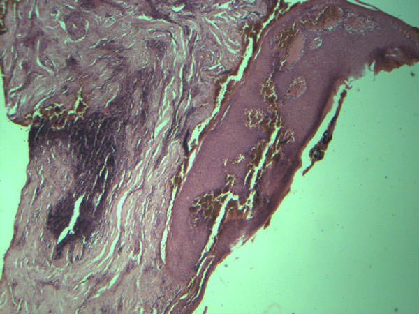 FIGURA 3 Epitelio escamoso se muestra en áreas acantósico, con hipergranulosis, vacuolización de la basal y exocitosis de linfocitos, alternando con áreas de ulceración.