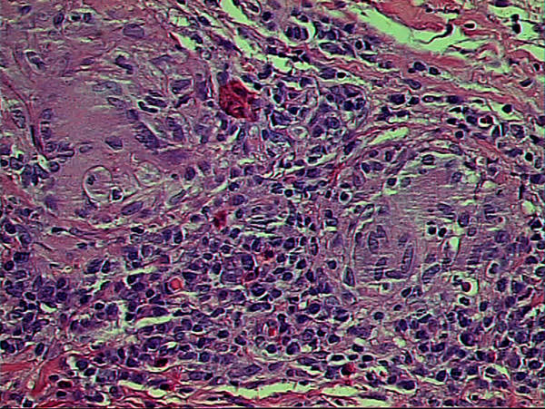 Figura 2 Histopatología de la lesión bucal exhibiendo granulomas típicos con células gigantes multinucleares e infiltrado inflamatorio crónico. HE X400