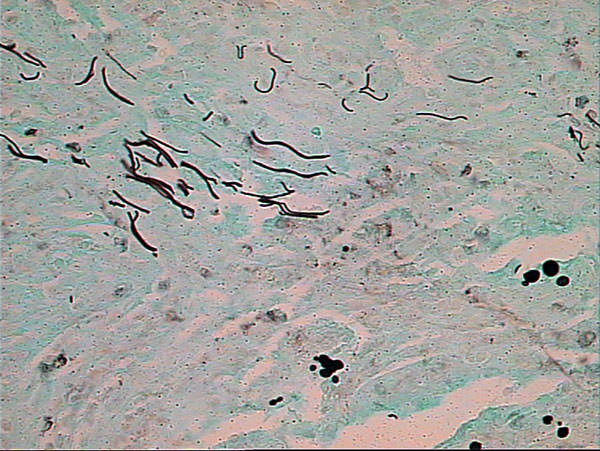 Figura 3 Presencia de hongos filamentosos y de paracoccidioides brasiliensies en el material biopsiado, evidenciado por la coloración especial. Metanamina-plata X400