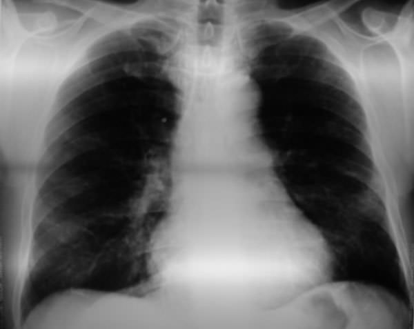 Figura 5 Ausencia de lesión pulmonar