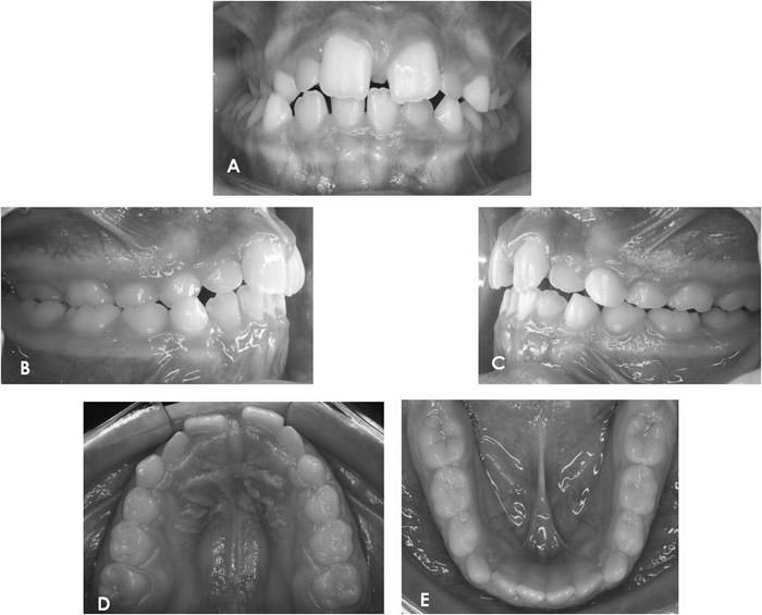 Figura 3 Fotos pretratamiento (A) Frontal; (B) Lateral derecha; (C) Lateral Izquierda; (D) Oclusal Superior y (E) Oclusal Inferior.