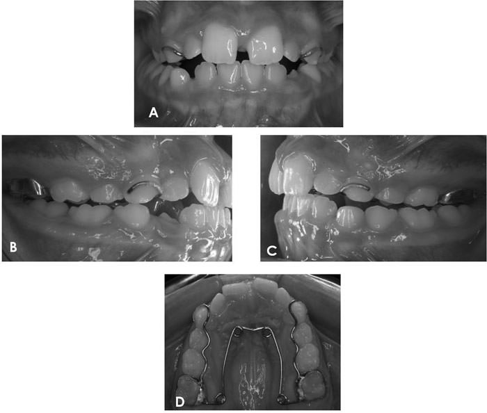 Figura. 4 Inicio del tratamiento. (A) Frontal; (B) Lateral derecha; (C) Lateral Izquierda y (D) Oclusal.