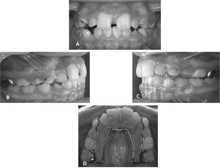 Figura 5 Fotos post expansión y comienzo de la etapa de contención. (A) Frontal; (B) Lateral derecha; (C) Lateral Izquierdo y (D) Oclusal.