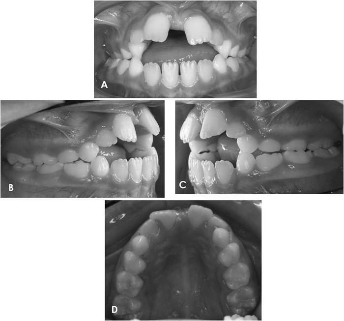 Figura 6 Fotos pretratamiento (A) Frontal; (B) Lateral derecha; (C) Lateral Izquierda; (D) Oclusal Superior.