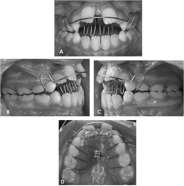 Figura 7 Inicio del tratamiento. (A) Frontal; (B) Lateral derecha; (C) Lateral Izquierda y (D) Oclusal.
