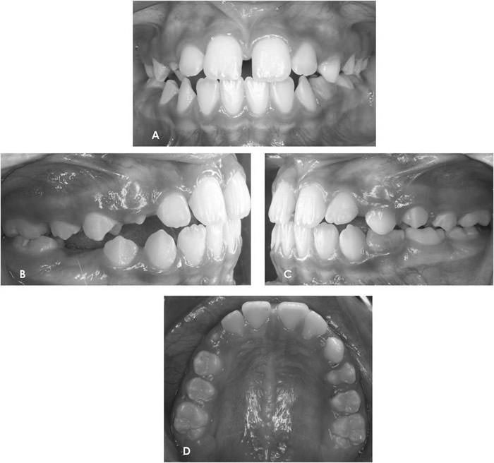 Figura 8 Fotos dos años post expansión y comienzo de la fase de contención. (A) Frontal; (B) Lateral derecha; (C) Lateral Izquierda y (D) Oclusal.