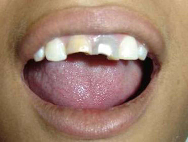 Figura 1 Valoración Clínica. Cambio de coloración en coronas de órganos dentarios 11 y 21