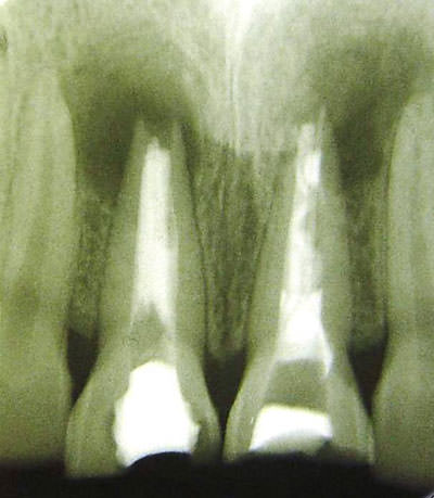 Figura 2 Radiografía Inicial. Zona Radio lúcida Apical. Ápices Inmaduros órganos dentarios 11 y 21
