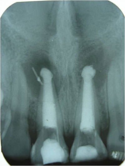 Figura 7 Obturación definitiva, tercios medio y coronal con gutapercha Técnica de Condensación Lateral