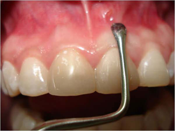 Figura 8 Clínica aparición de fistula en Mucosa vestibular órgano dentario 21 (30 días después al tratamiento)