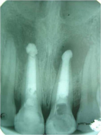Figura 9 Radiografía Pre quirúrgica. Nótese la desaparición del material radiopaco en el periapice de órgano dentario 21 (8 días posterior aparición de fistula).
