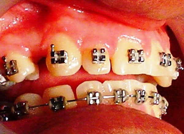 Figura 1 Presencia de diastema entre el canino y el premolar, con presencia de rugosidades en la cara distal del canino correspondiente a una reabsorción por la presión de las fuerzas ortodóncicas con el hueso.