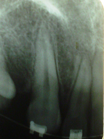 Figura 2 Aumento de la condensación del hueso, disminución de la cresta ósea además de una dilaceración en la cara distal del canino, con ensanchamiento del ligamento periodontal.
