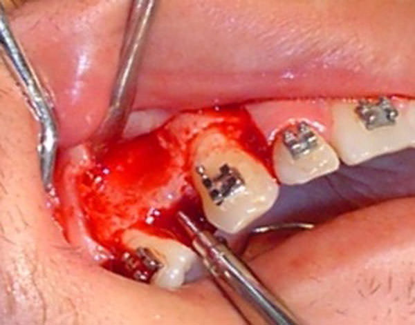 Figura 4 Separación de las tablas óseas con el cincel y martillo, en el sitio de contacto con el hueso, dando la apariencia de un principio de reabsorción por la intensidad de la fuerza y la resistencia del hueso ante el movimiento dental.
