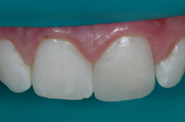 Figura 8 Último incremento realizado con resina de esmalte acromático (4 Seasons High Value), adaptado en el tercio incisal de la superficie vestibular.