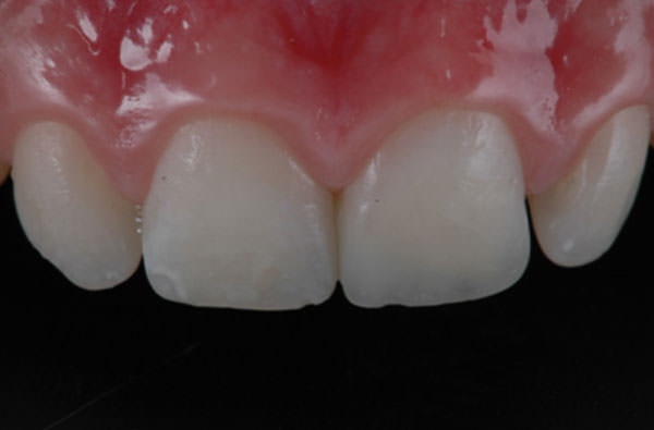 Figura 9a. Vista frontal del caso finalizado. El uso de la técnica de multicapas (estratificación) permitió conseguir una restauración biomimética en color y translucidez.