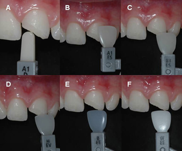 Figura 2 a) Selección del color de resina opaca para dentina, b) y c) Selección de los colores de esmalte cromático y d) acromático.