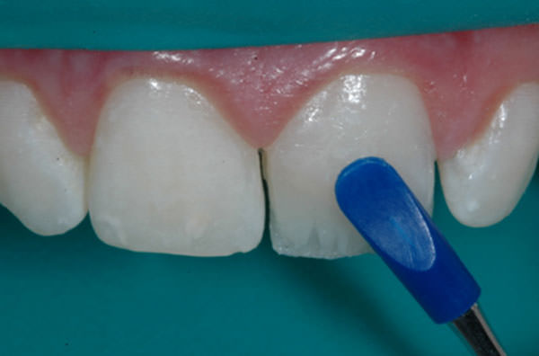 Figura 4 Resina opaca (4 Seasons A2 dentin) llevada hasta 1,0 mm del borde incisal dando anatomía a los mamelones dentinarios.