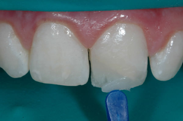 Figura 5 Resina de efecto azulado (4 Seasons Blue Effect), adaptada sobre y entre los mamelones dentinarios, permite reproducir la opalescencia del tercio incisal.