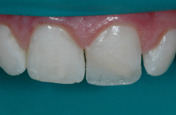 Figura 6 Uso de resina de efecto blanquecino (4 Seasons White Effect) para reproducción del halo opaco incisal.