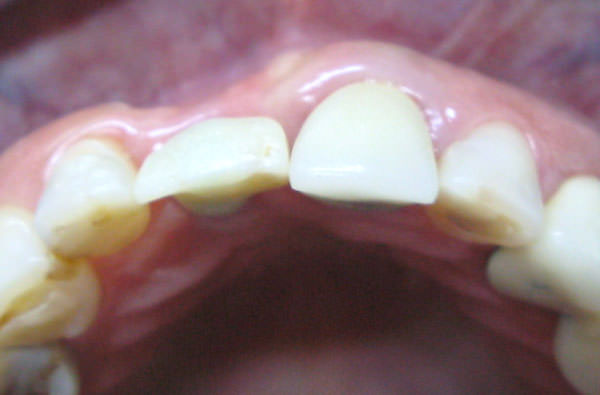 Figura 1 Estado inicial del paciente posterior a la colocación del implante dental. Se denota la disminución de tejido queratinizado subsecuente al colapso alveolar.